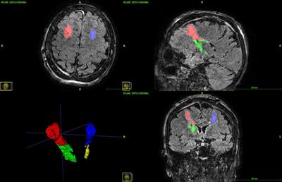 Peri-lead edema and local field potential correlation in post-surgery subthalamic nucleus deep brain stimulation patients